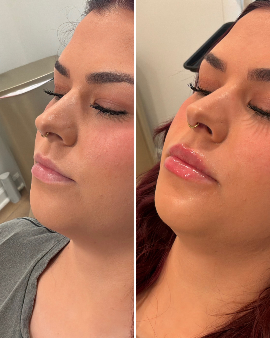 LIP FILLER