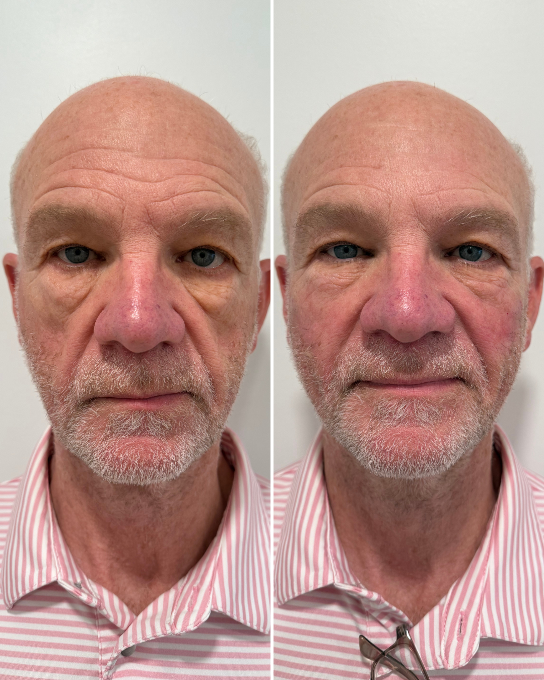 FACIAL BALANCING