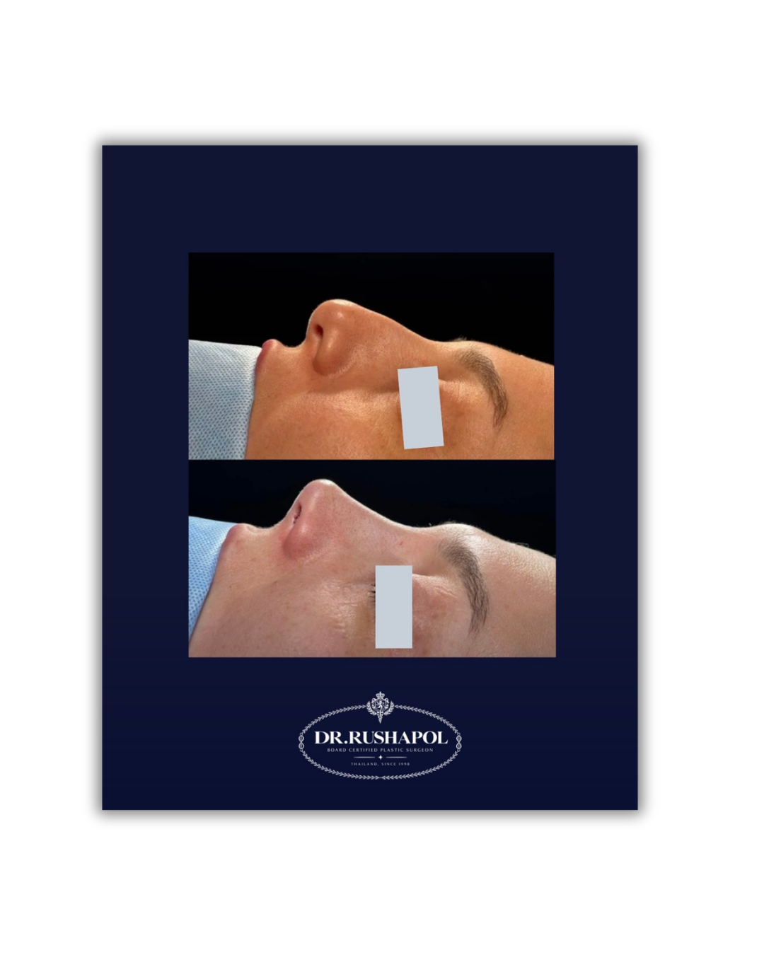Before and after images of a nose reshaping procedure by Dr. Rushapol, showing improved nasal profile.