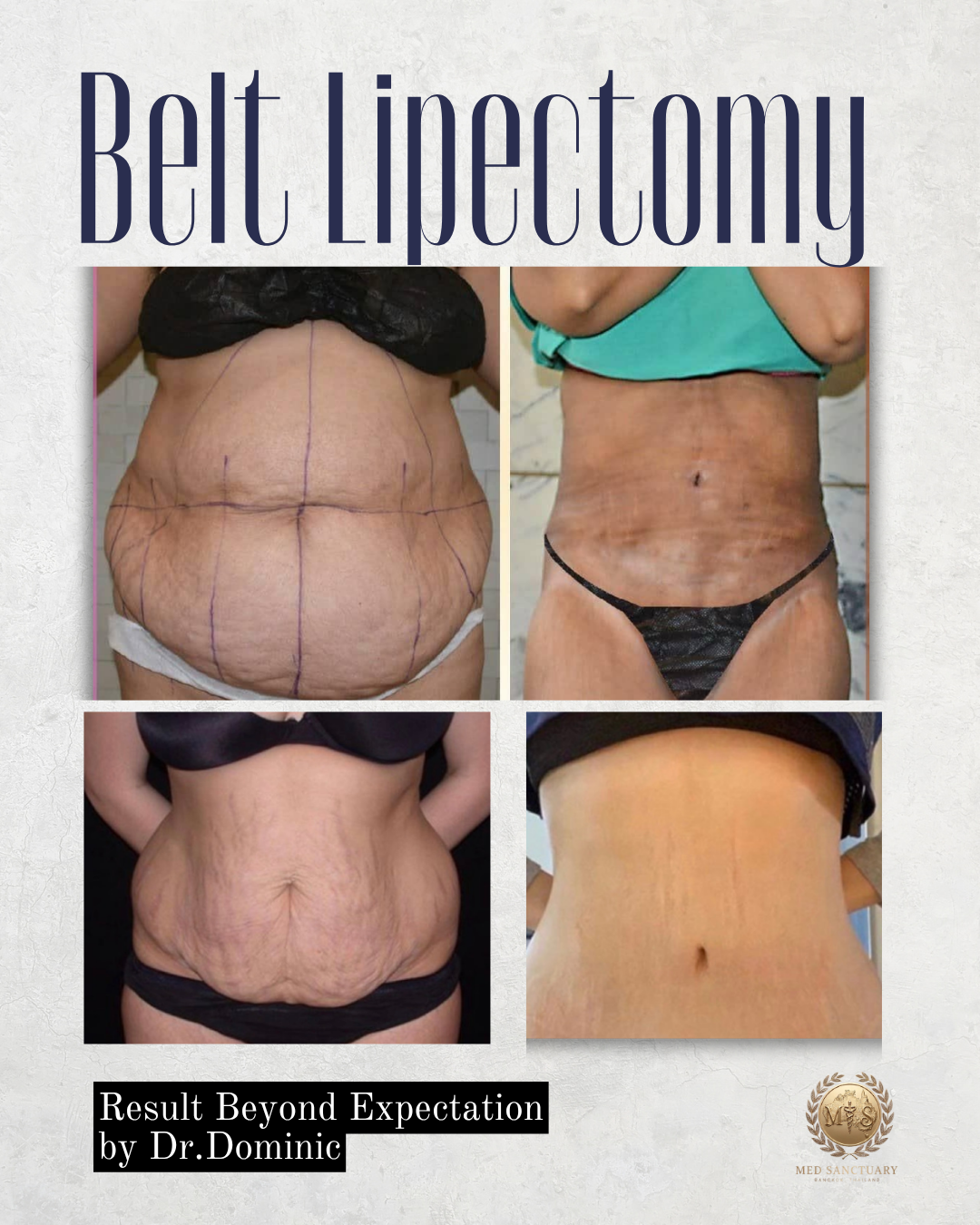 A collage of before and after photos showing the results of belt lipectomy on a woman's stomach, with noticeable reduction in excess skin and fat. Text on the image reads 'Belt Lipectomy' and 'Result Beyond Expectation by Dr. Dominic.'