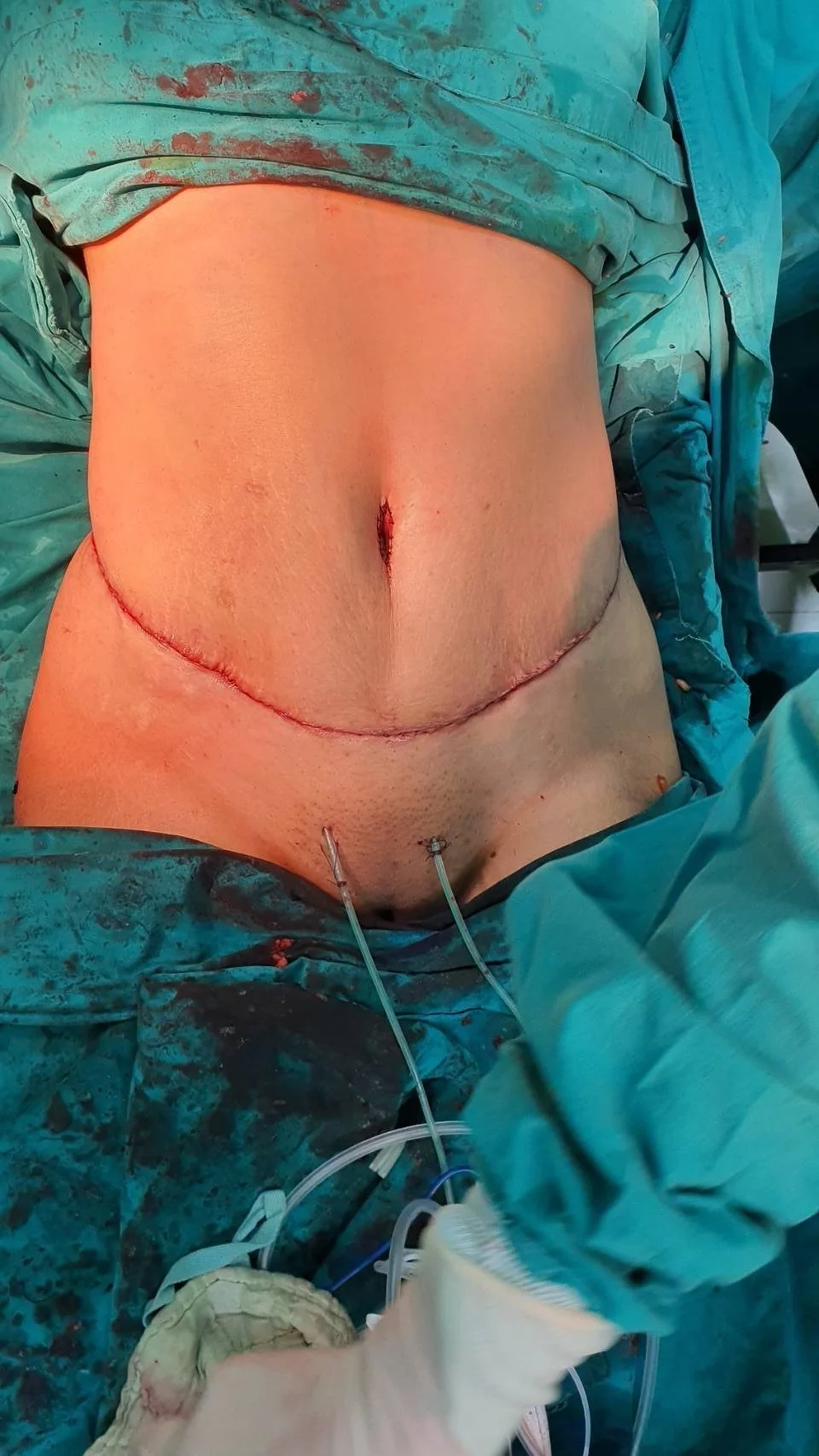A patient undergoing abdominal surgery with visible surgical incision and medical tubes and equipment.