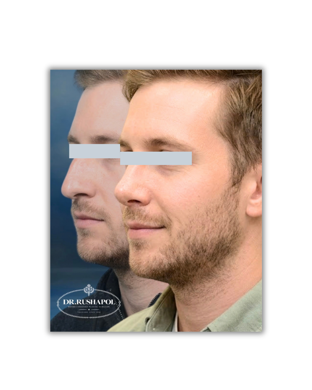 Side-by-side comparison of a man's face before and after cosmetic procedure, with a blurred rectangle covering the eyes and a logo for Dr. Rushapol at the bottom.