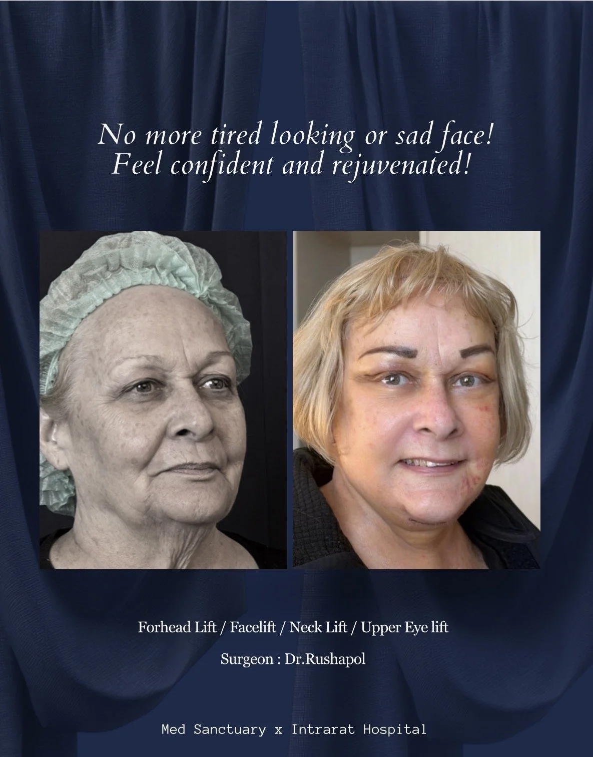 Side-by-side before and after photos of a woman who has undergone facial and neck rejuvenation procedures, including forehead lift, face lift, neck lift, and upper eyelid lift. The left image shows her before surgery with aged skin, while the right i