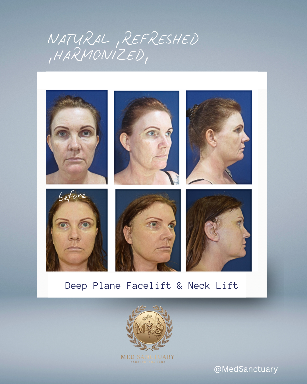 Before and after photos showing a woman's face and profile, demonstrating a deep plane facelift and neck lift procedure at Med Sanctuary in Bangkok, Thailand.