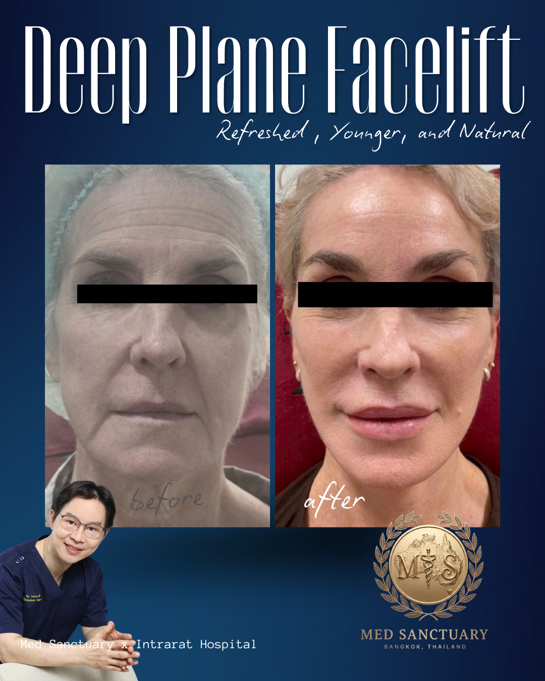 Side-by-side comparison of a woman's face before and after a deep plane facelift, showing reduced wrinkles and a more youthful appearance, with a doctor from Med Sanctuary Bangkok, Thailand, in the bottom left corner.