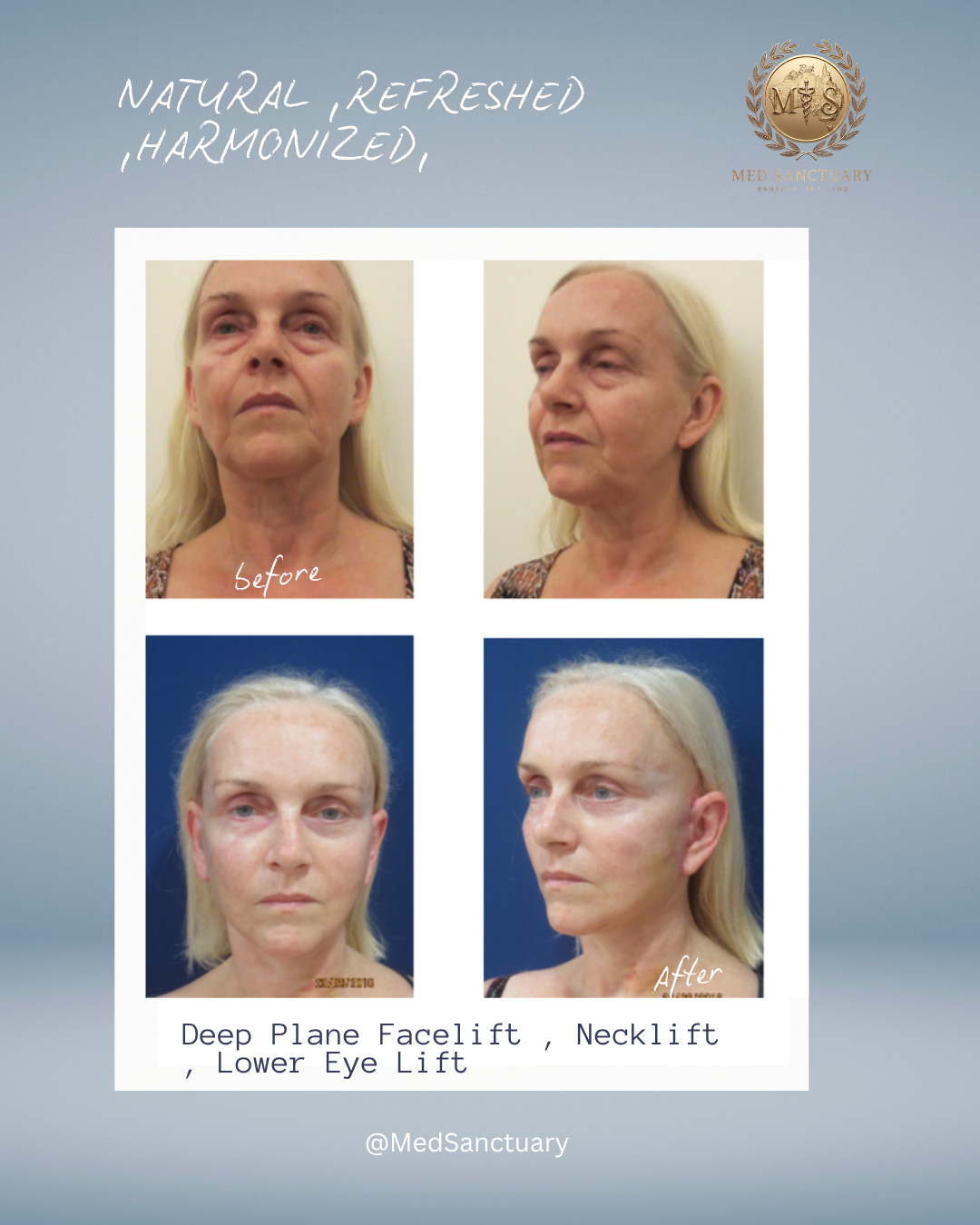 Before-and-after photos showing the results of deep plane facelift, neck lift, and lower eye lift on an elderly woman, with the "before" images on top and "after" images on the bottom.