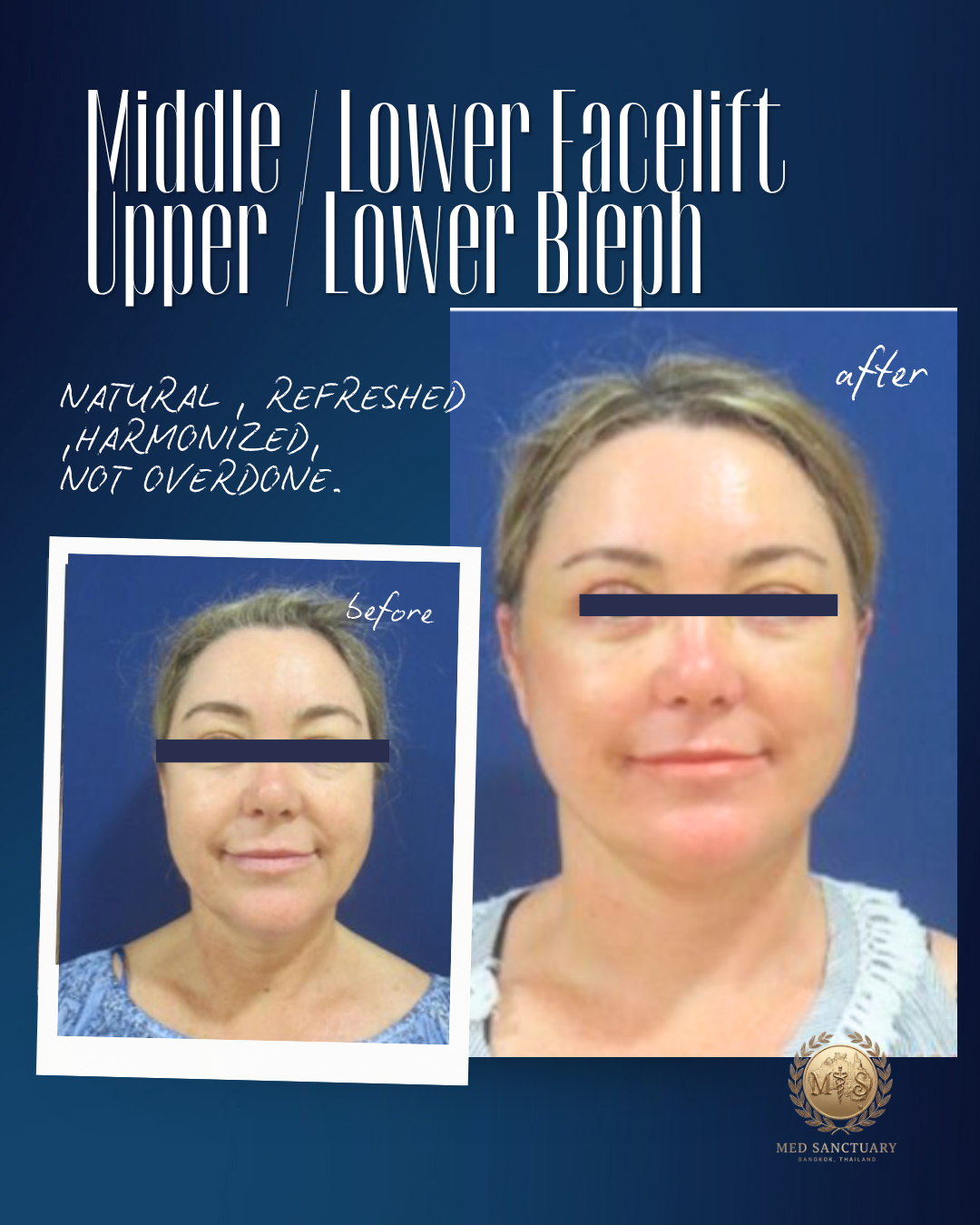 Before and after images of a woman's face showing facial lifting results, with text indicating 'Middle / Upper', 'Lower / Face Lift', 'Lower / BlepH', and notes that results are natural, refreshed, and not overdone.