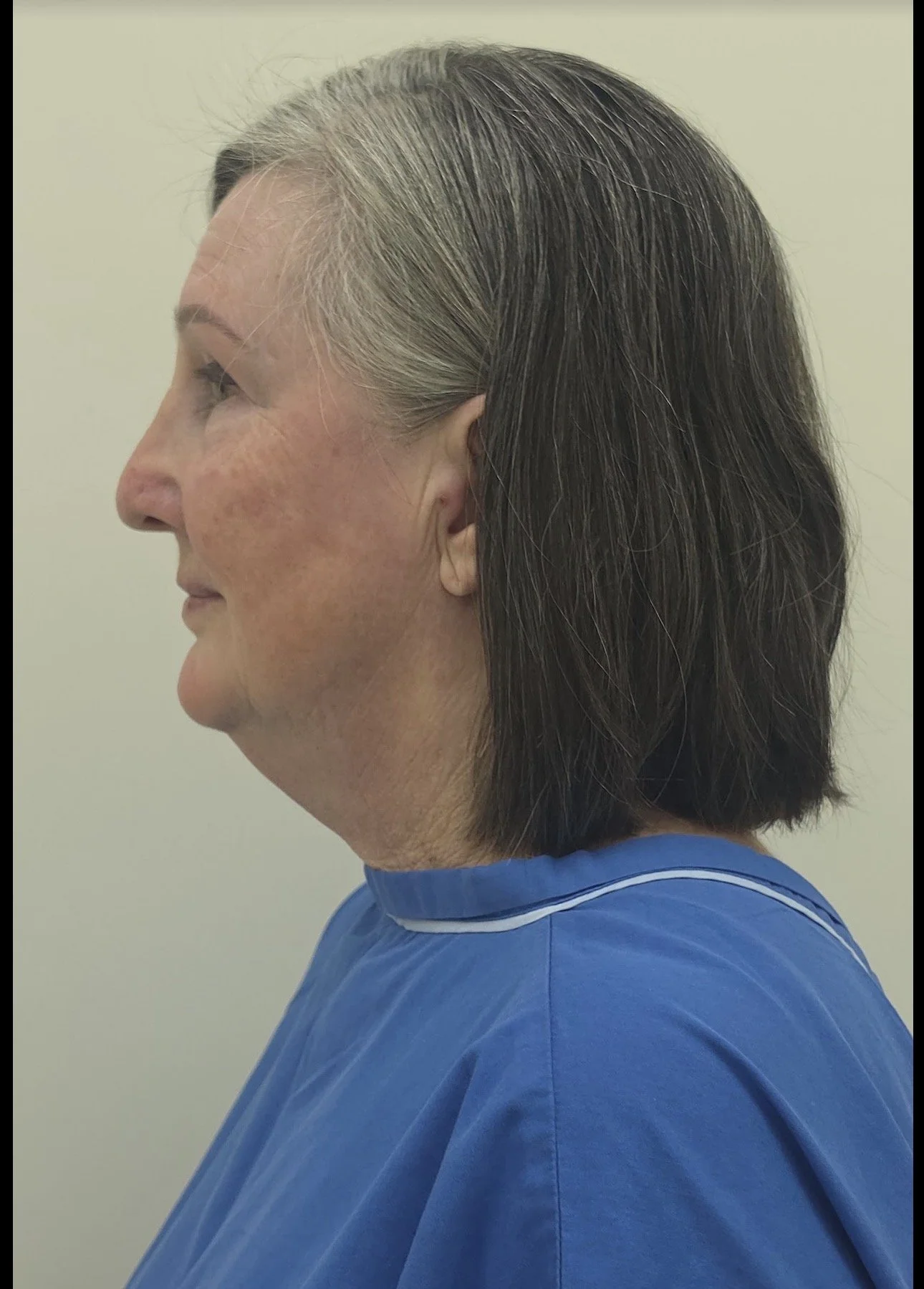 Monica’s Facelift Transformation