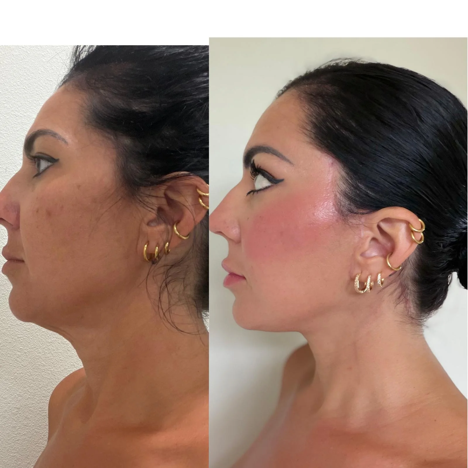 Deep Plane vs SMAS vs Mini vs Ponytail: A Surgeon's Guide to Facelift Techniques