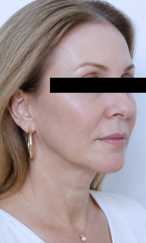 Do facelifts look natural? The signs of an overdone facelift and how to avoid them