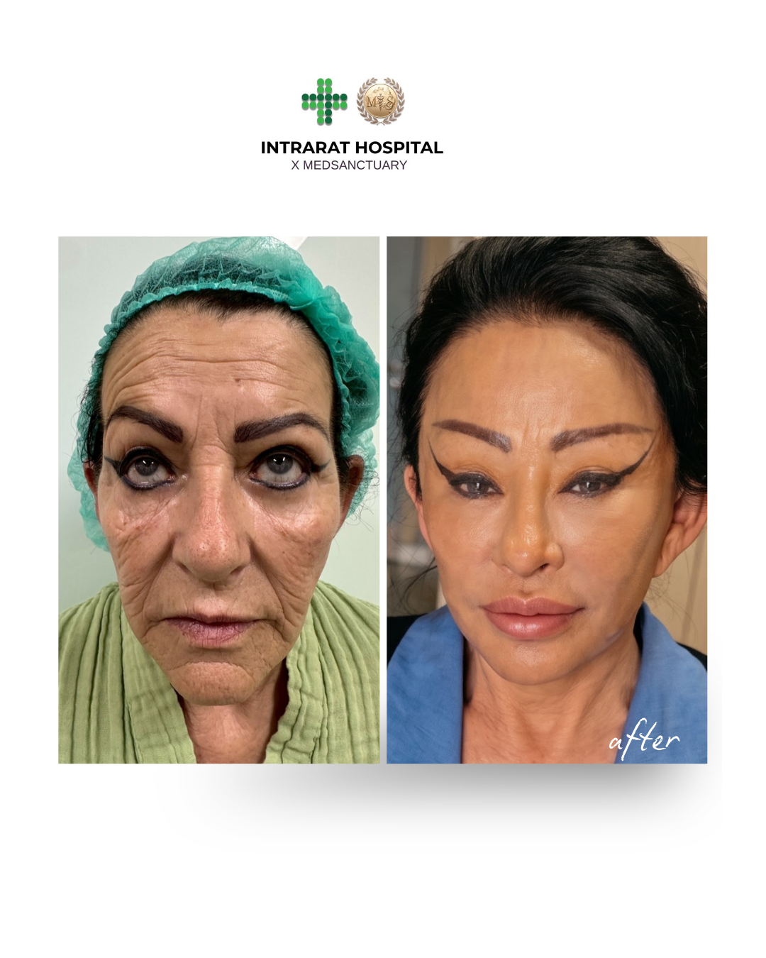 before after - 4.png
