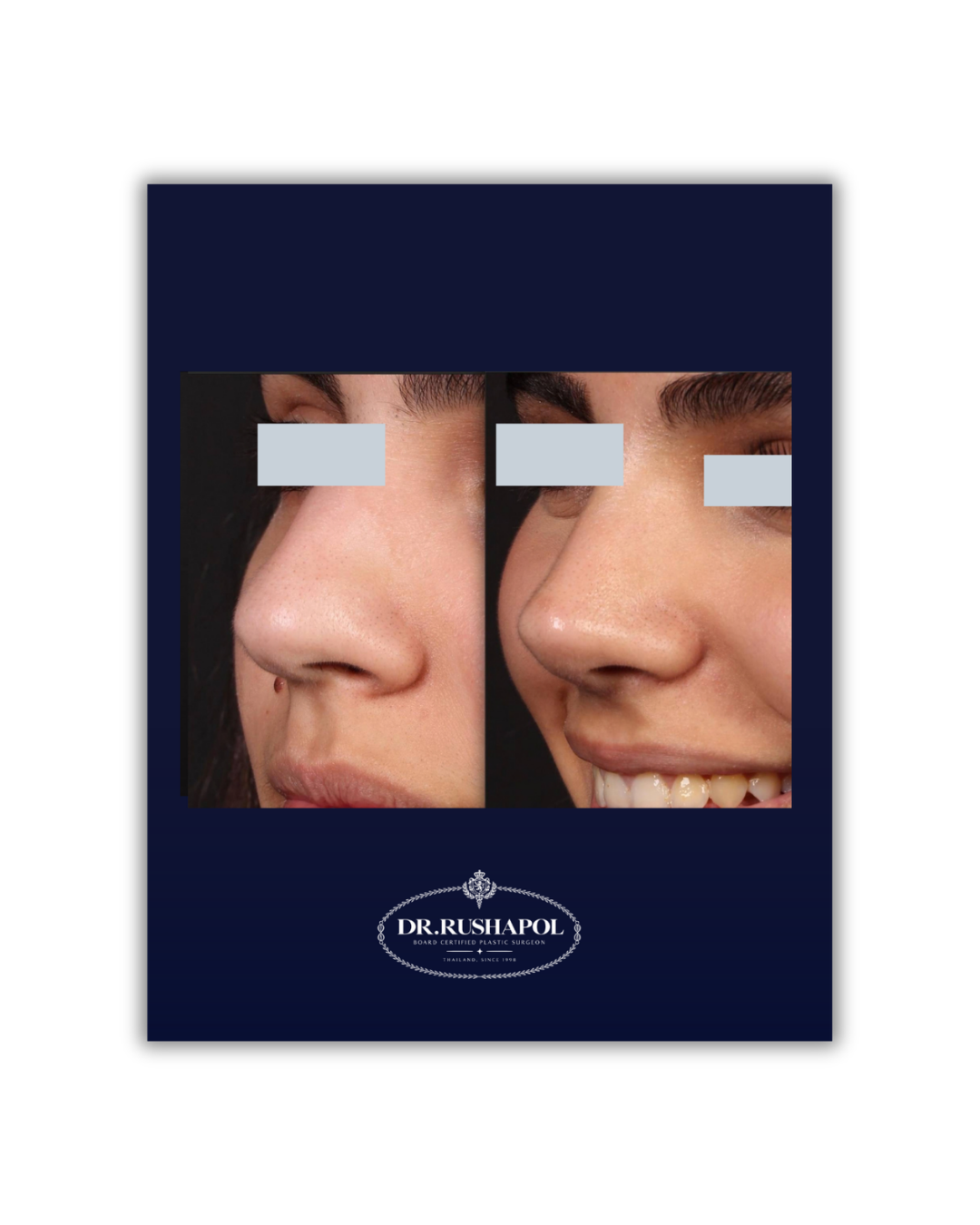Before and after photos of a woman's nose and smile, showing cosmetic improvements, with the text 'DR. RUSHAPOL' at the bottom.