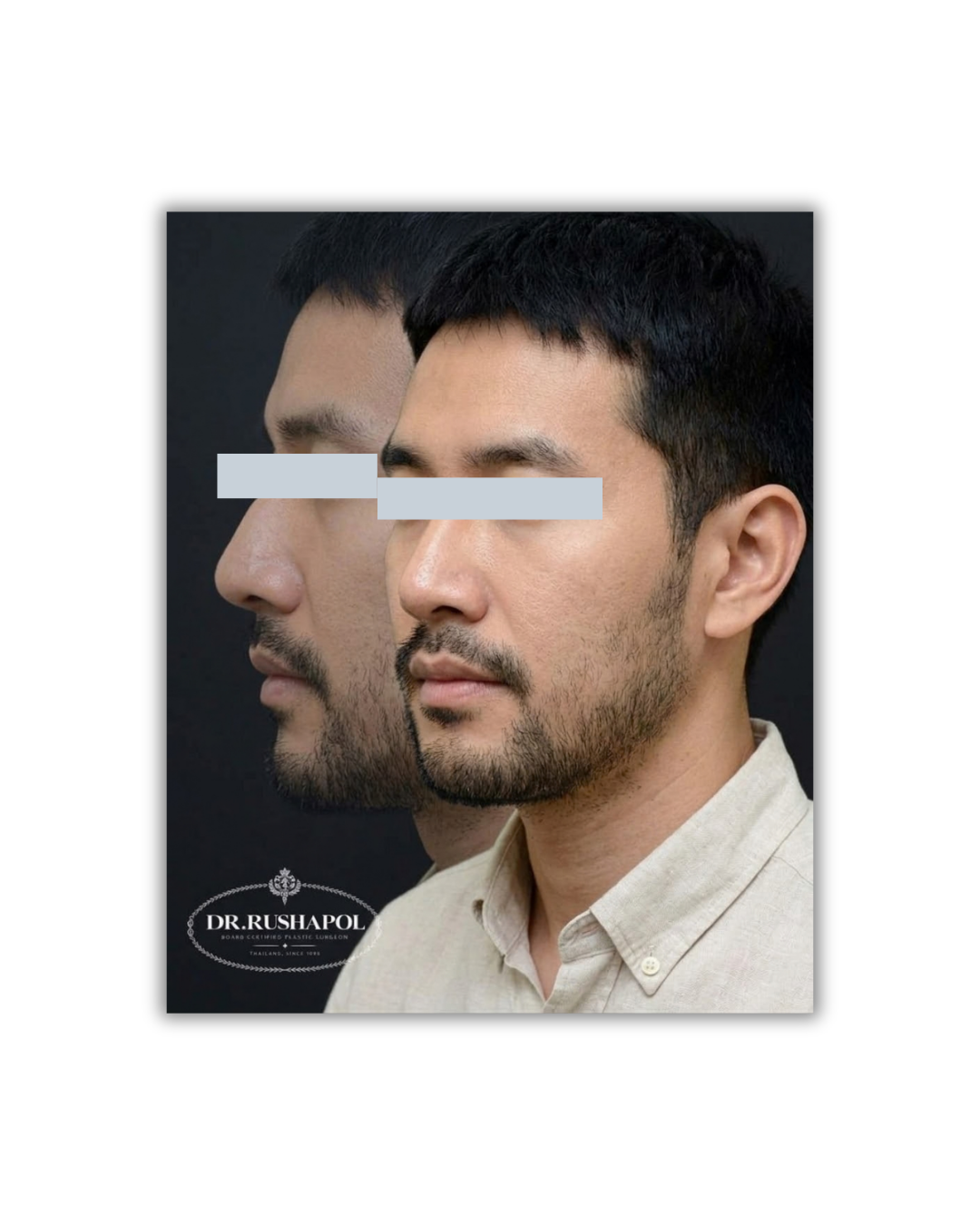 Side-by-side comparison of a man's face before and after a cosmetic procedure, showing improvements in facial features.