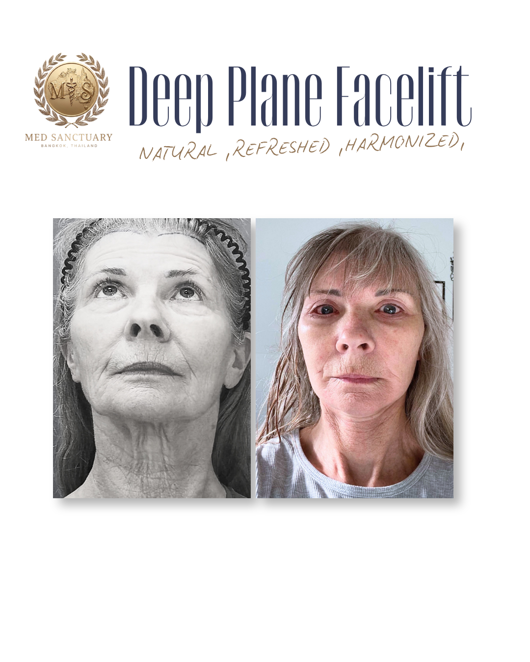 Comparison of a black and white photo of an older woman with visible wrinkles on the left and a color photo of the same woman with less visible wrinkles on the right, showing a skincare or aesthetic treatment result.