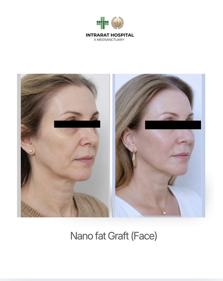 Before and after photos of a woman showing the results of a nano fat graft on her face, with the hospital logo and text at the top.