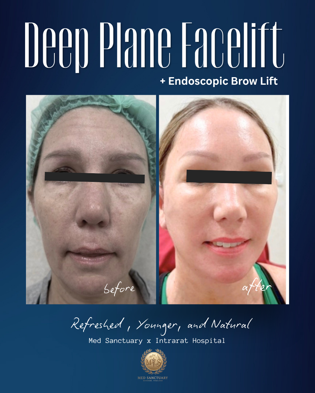 A side-by-side comparison of a woman's face before and after deep plane facelift and endoscopic brow lift, showing rejuvenated appearance with smoother skin and lifted brows, from Med Sanctuary and Intrarat Hospital.