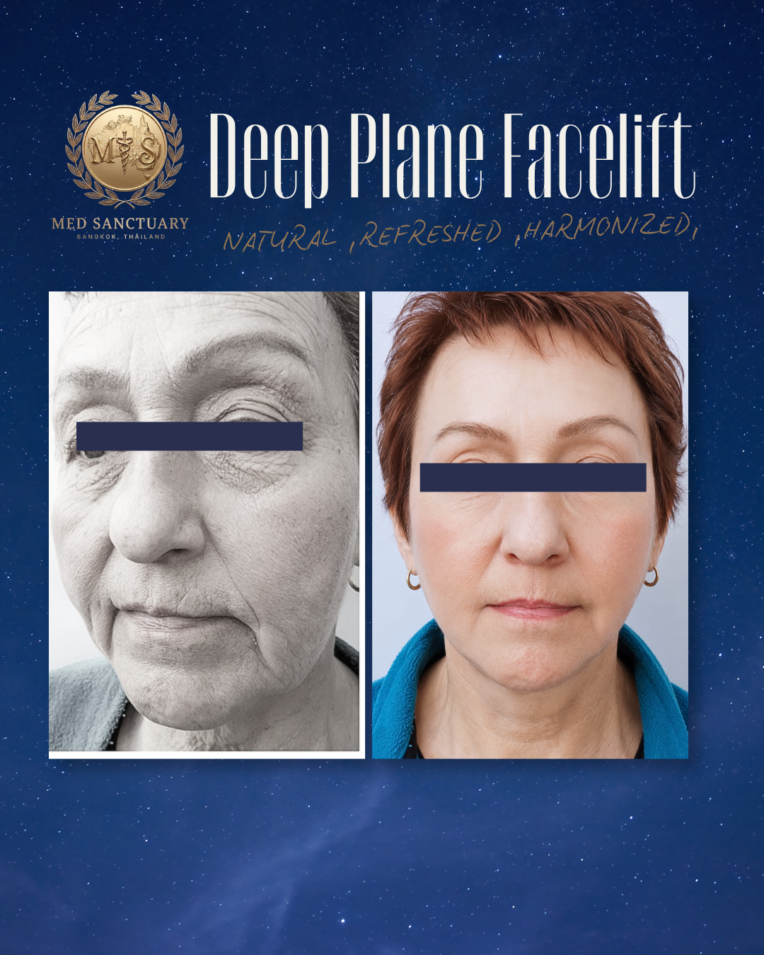 A before and after comparison of a woman's face showing signs of aging on the left and a more youthful appearance on the right, with a background of a starry night sky and the words "Deep Plane Facelift" and "Natural, Refreshed, Harmonized".