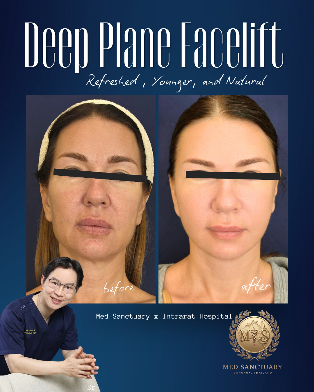Before and after photos of a woman's face showing a deep plane facelift procedure, with the before image on the left and the after image on the right. The images emphasize a more youthful and natural appearance post-surgery. The background is dark bl