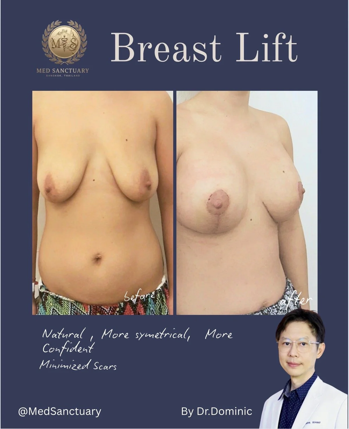 Before and after photos of a woman showing breast lift surgery results, with text indicating improved symmetry, confidence, and minimized scars, and featuring a doctor in the bottom right corner.
