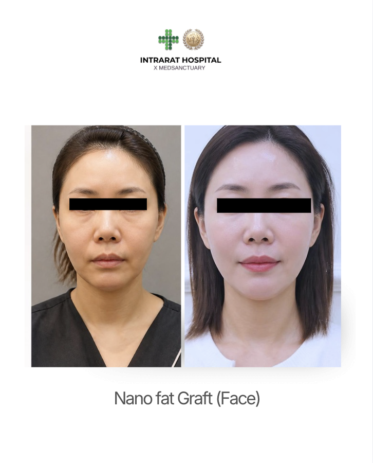 Side-by-side before and after photos of a woman showing face transformation from Nano Fat Graft at Intrarart Hospital.