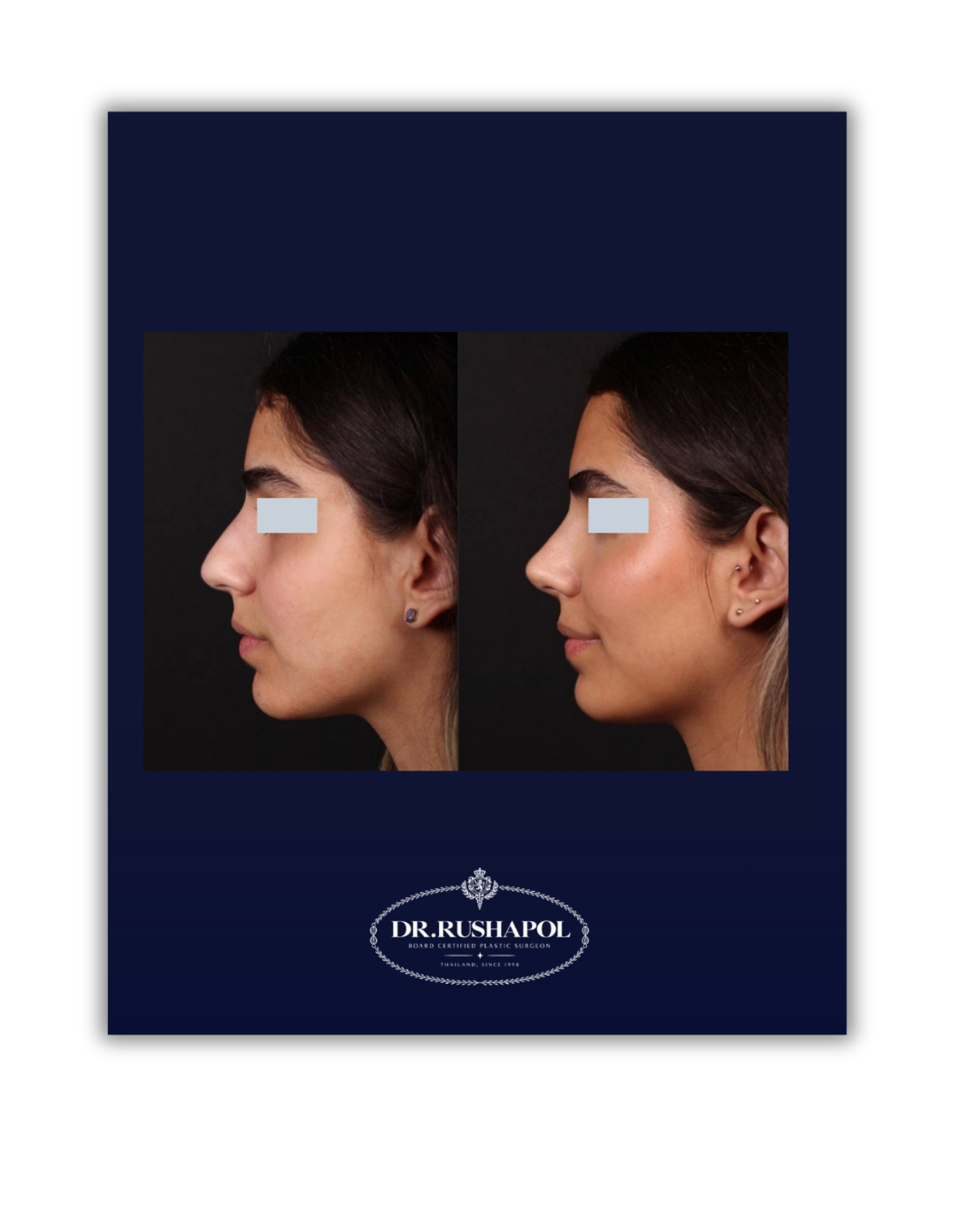 Side-by-side before and after photos of a woman showing her profile, indicating facial or cosmetic improvements from a procedure by Dr. Rushapol.