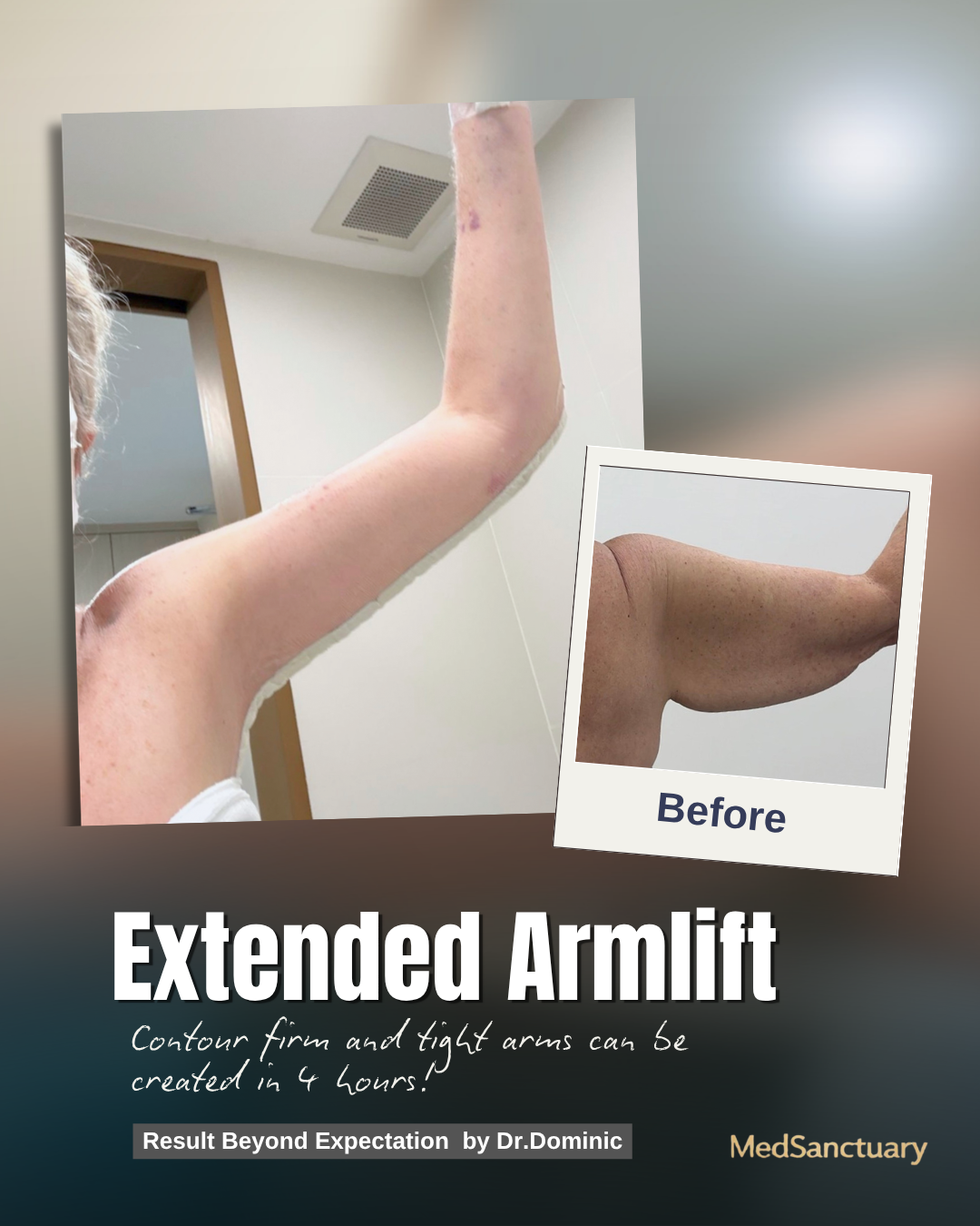 Promotional poster displaying before and after pictures of an arm, highlighting extended armlift results. The 'before' photo shows a sagging upper arm, while the main image shows a tightened, lifted arm. Text includes "Extended Armlift," "Contour fir