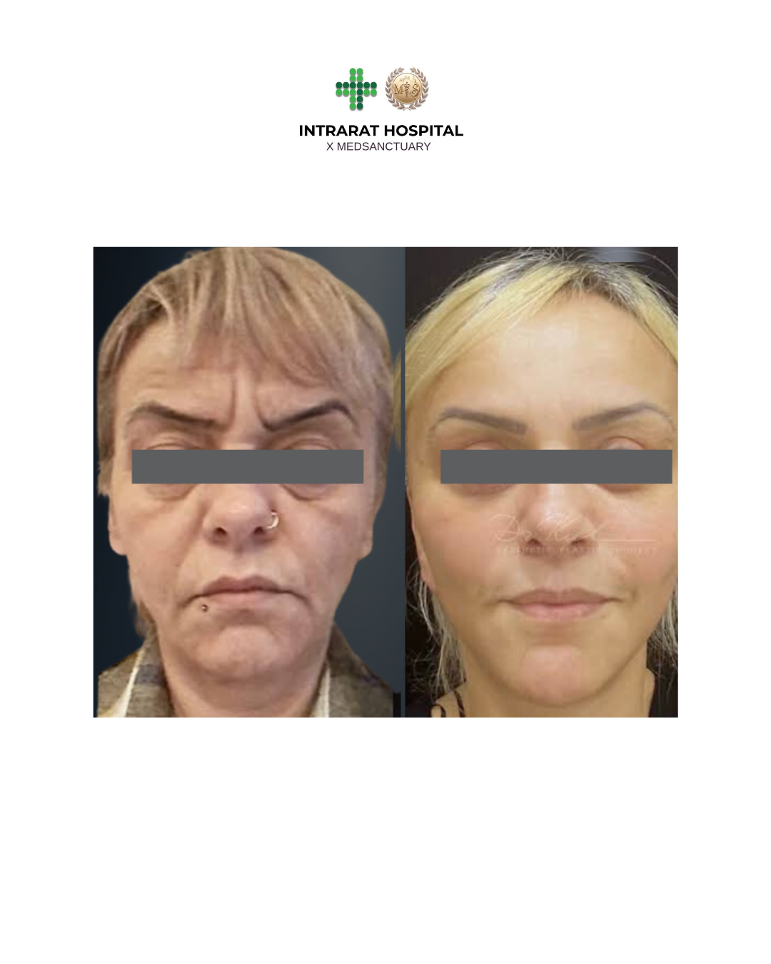 before after - 73.png
