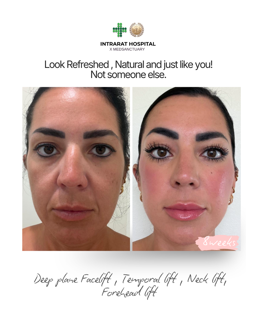 Side-by-side before and after photos of a woman showing her facial transformation after 8 weeks of deep plane facelift, temporal lift, neck lift, and forehead lift at an inpatient hospital.