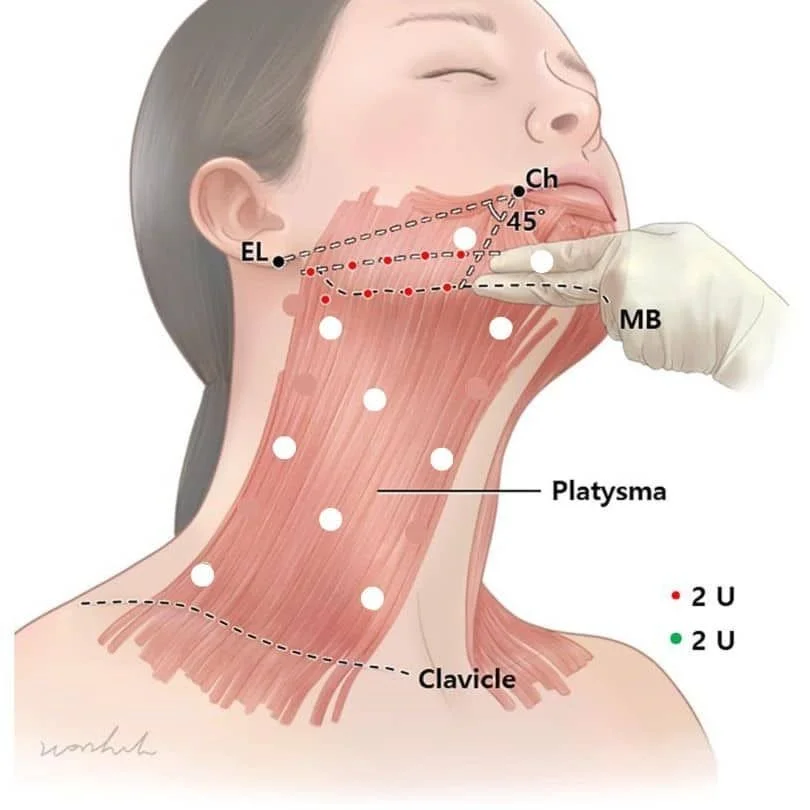 Anatomical diagram of the platysma muscle and neck structures addressed in a neck lift