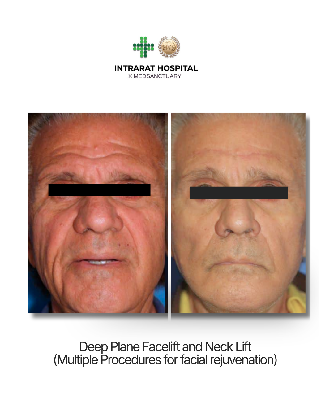 Side-by-side before-and-after photos showing a man's face after deep plane facelift and neck lift procedures for facial rejuvenation.