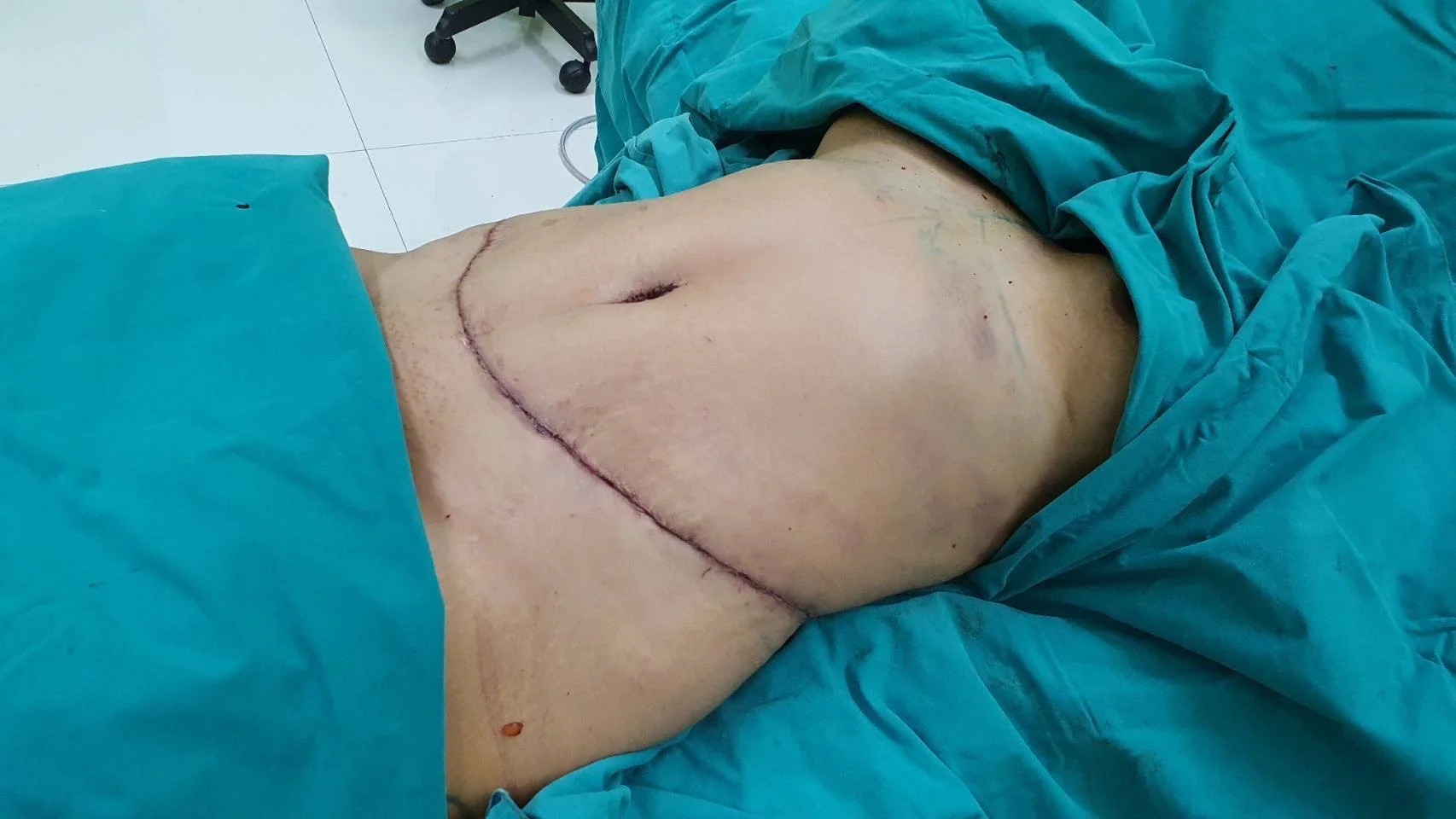 A person lying on an operating table with surgical markings on their abdomen, prepared for surgery. The individual is covered with blue surgical drapes, and the scene appears to be in an operating room.