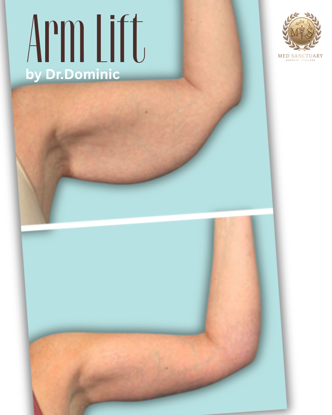 Poster showing before and after images of a woman's arm undergoing arm lift surgery, with text indicating 'Arm Lift by Dr. Dominic' and a logo for Med Sanctuary Bangkok, Thailand.