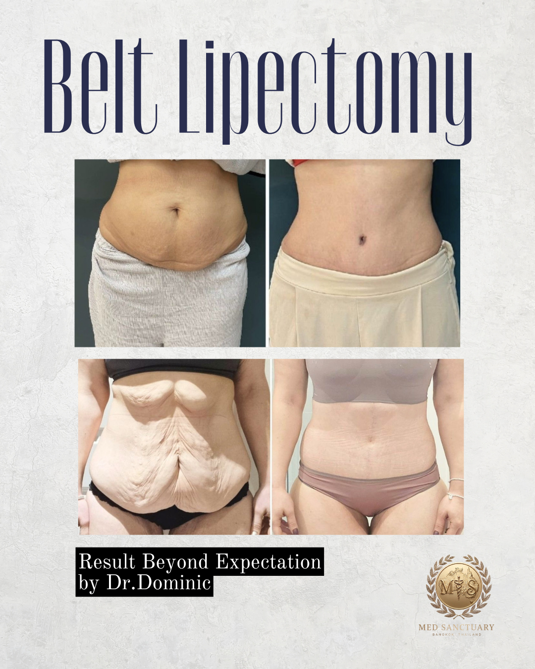 Before and after images of a woman's abdomen showing weight loss and skin tightening following belt lipectomy surgery, with text indicating results beyond expectations by Dr. Dominic, and a logo for Med Sanctuary in Bangkok, Thailand.