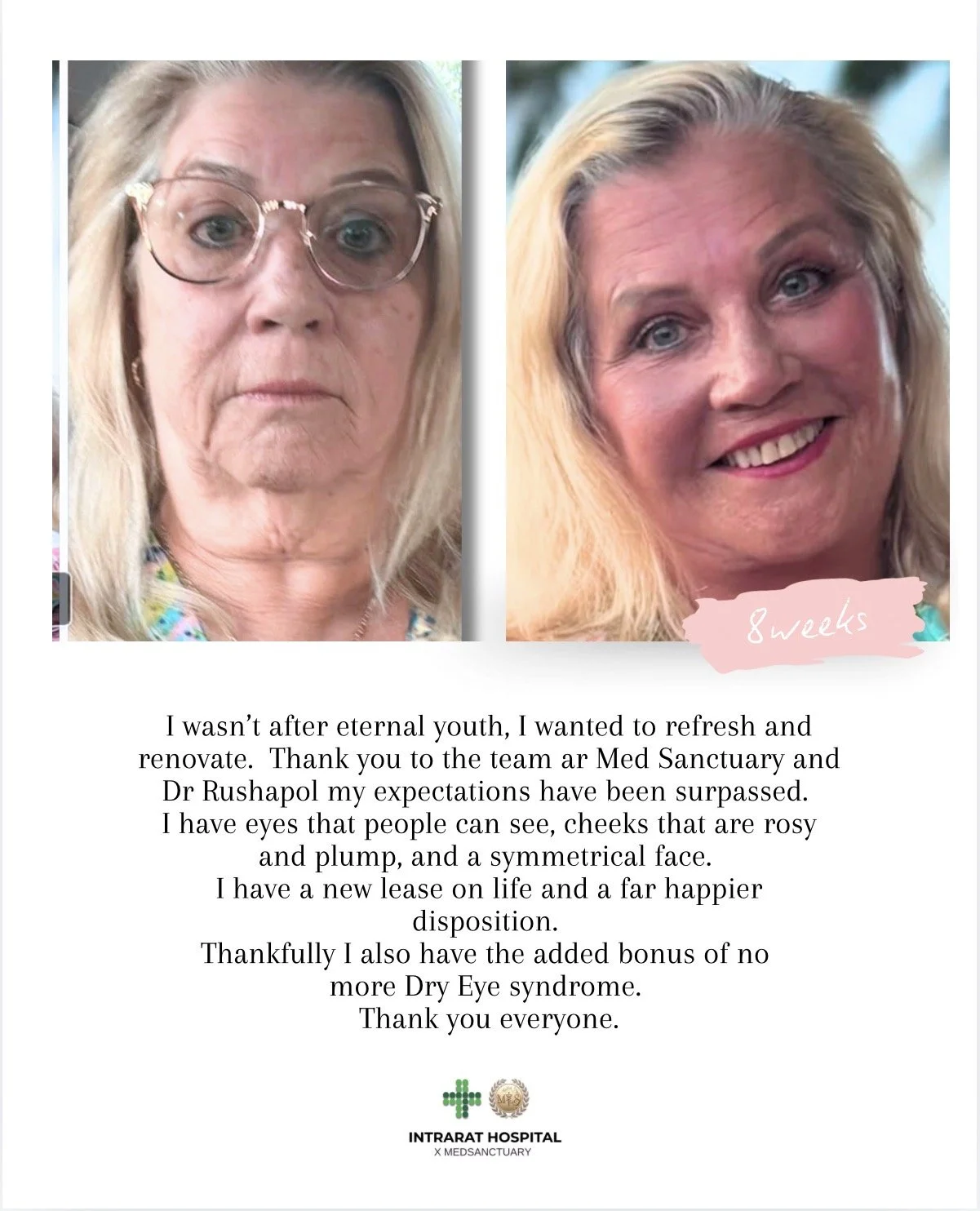 Side-by-side comparison of a woman's face at 8 weeks before and after cosmetic treatment, showing improved skin and appearance.