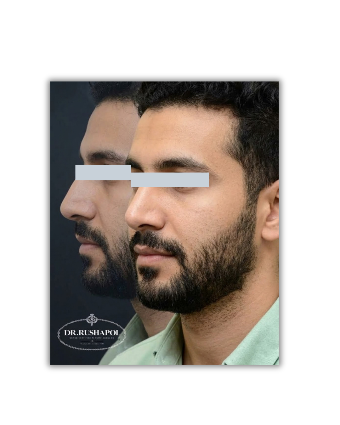 Side-by-side profile photos of a man before and after cosmetic procedure, showing facial changes, with logo of Dr. Rushapol at the bottom.