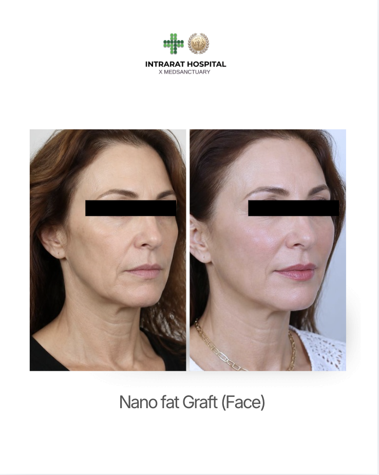 Side-by-side images showing a woman's face before and after nano fat graft cosmetic procedure at Intrarat Hospital, with a logo and hospital name at the top.