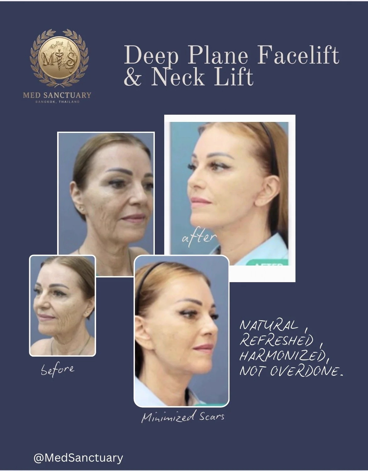 Comparison of a woman's face before and after a deep plane facelift and neck lift procedure, showing minimized scars, natural and refreshed appearance.