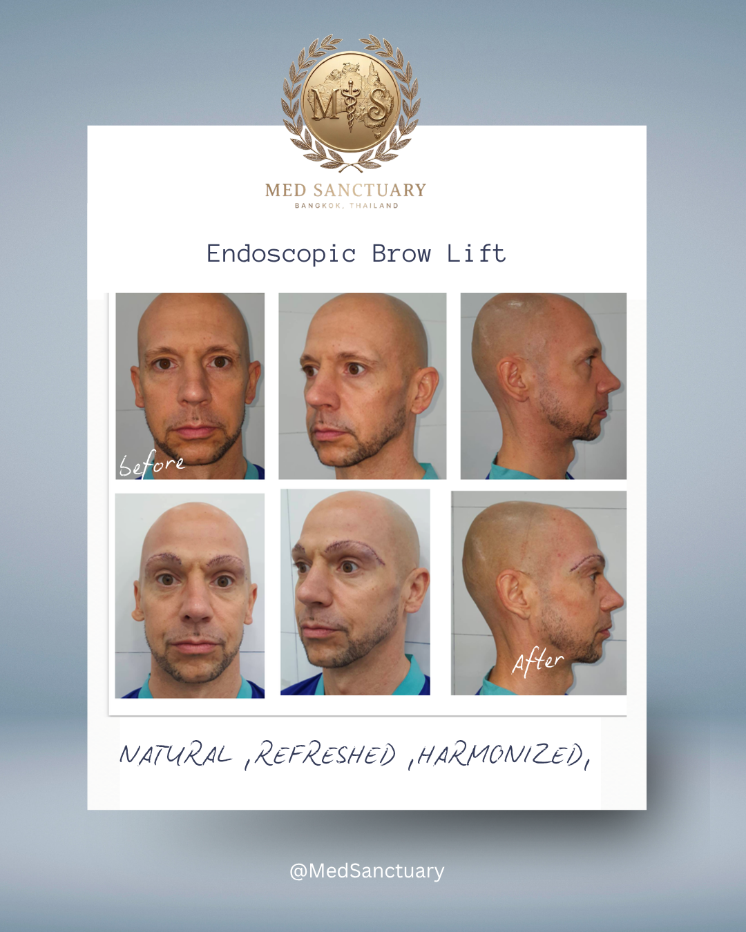Before and after photos of a man who underwent endoscopic brow lift at Med Sanctuary in Bangkok, Thailand. The images display the man's facial appearance from front and side views, showcasing the results of the procedure with a more natural, refreshe