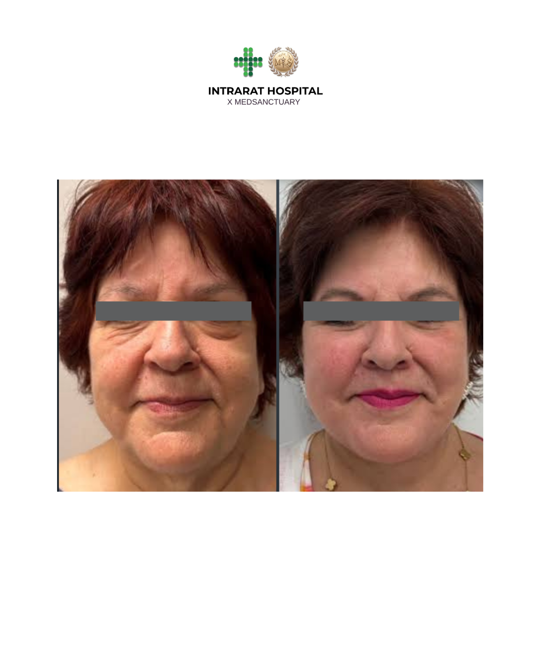 before after - 74.png