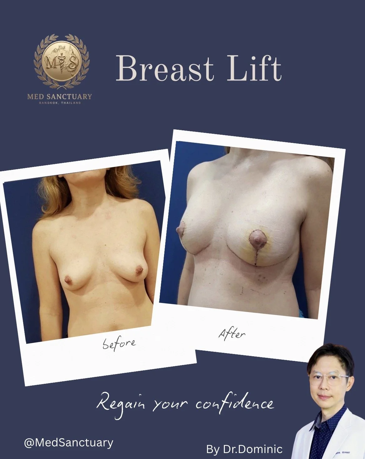 Advertisement for a breast lift procedure showing before and after photos of a woman's chest, with a doctor in the lower right corner, promoting confidence restoration at Med Sanctuary Bangkok, Thailand.