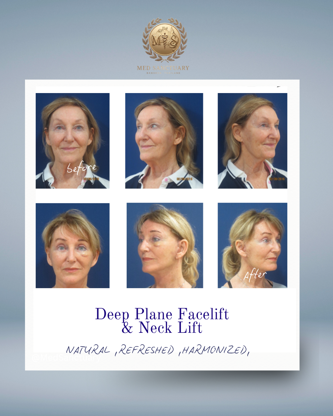 Before and after photos of a woman showing the results of deep plane facelift and neck lift, with the logo and name of Med Sanctuary in Thailand.