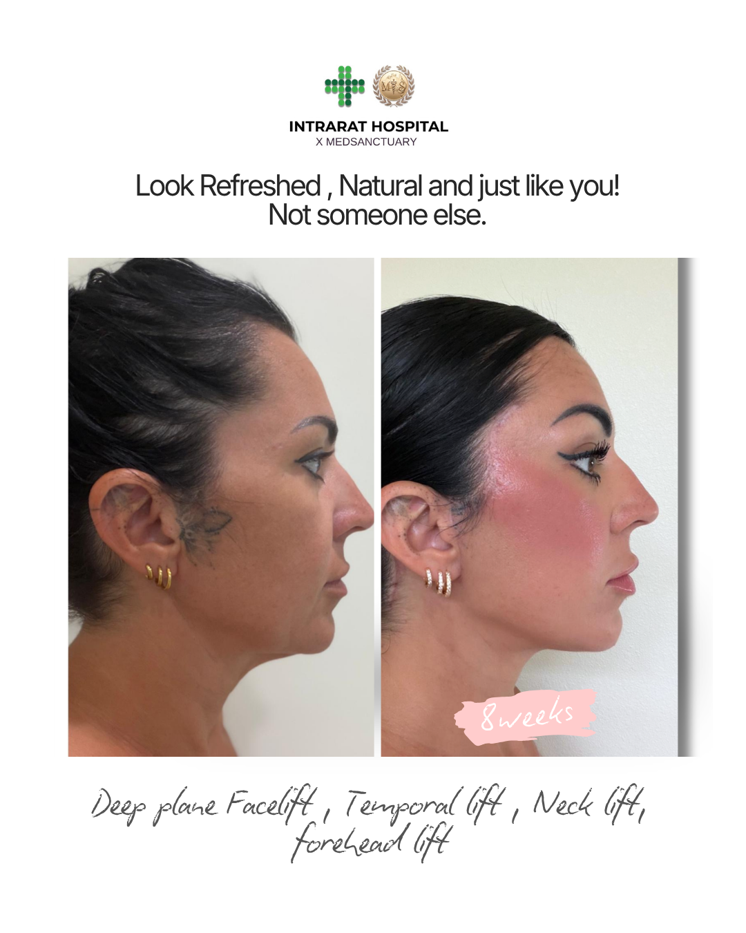 Side-by-side before and after photos of a woman, showing facial features, makeup, and jewelry. The after photo indicates 8 weeks following a deep plane facelift, temporal lift, neck lift, and forehead lift. The top text promotes a hospital's rejuvena