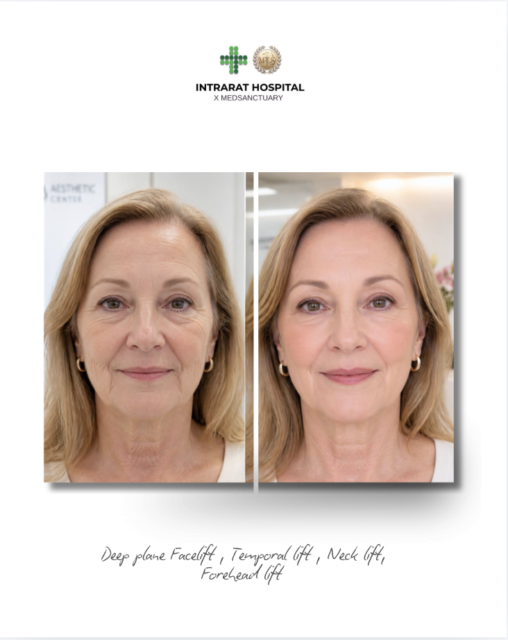 Before and after photos of a middle-aged woman showing facial improvements following cosmetic procedures, with the logo of Intraral Hospital at the top and notes about the treatments at the bottom.