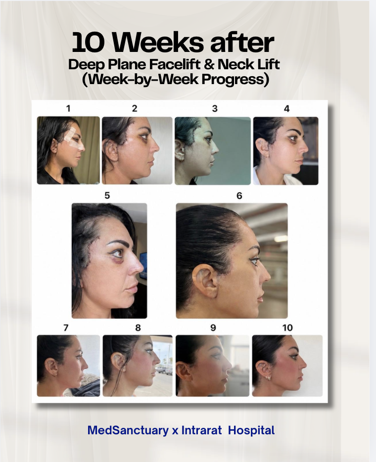 Timeline of a patient's face showing the progress of deep plane facelift and neck lift over ten weeks with photos labeled from 1 to 10.