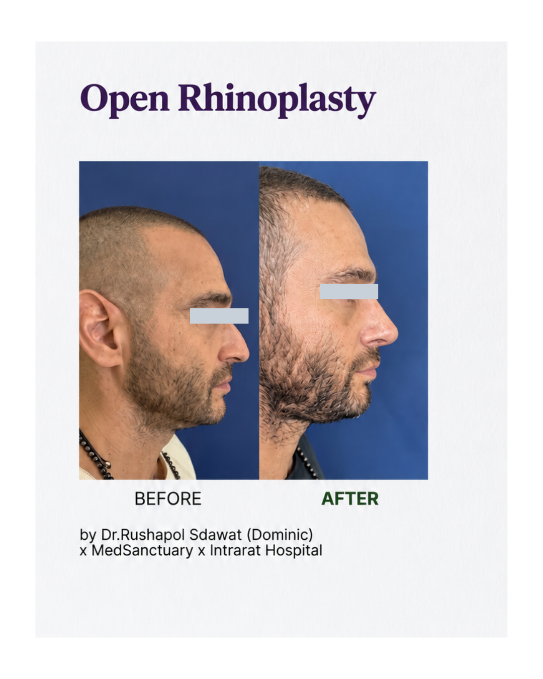 Before and after photos showing the results of open rhinoplasty on a man, with a more prominent nose after the procedure. The image is part of a promotional flyer by Dr. Rushapal Sdawat, indicating the procedure was performed at MedSanctuary and Intr