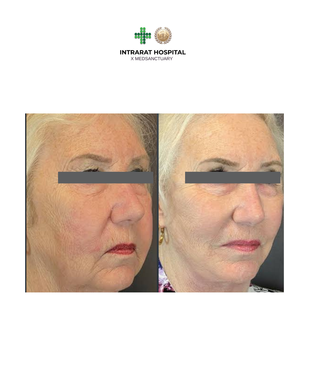 before after - 72.png