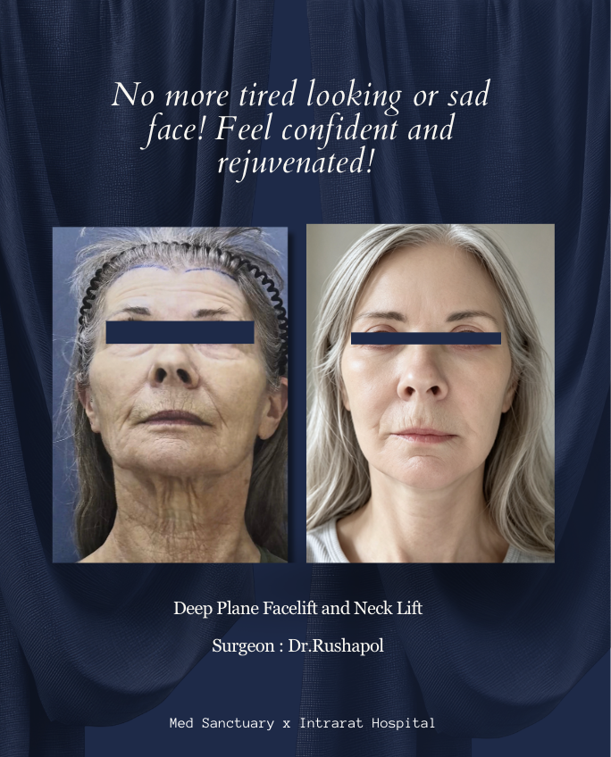 Before and after photos of a woman showing facial rejuvenation, with text promoting deep plane facelift and neck lift performed by Dr. Rushapol at Med Sanctuary and Intrarat Hospital.