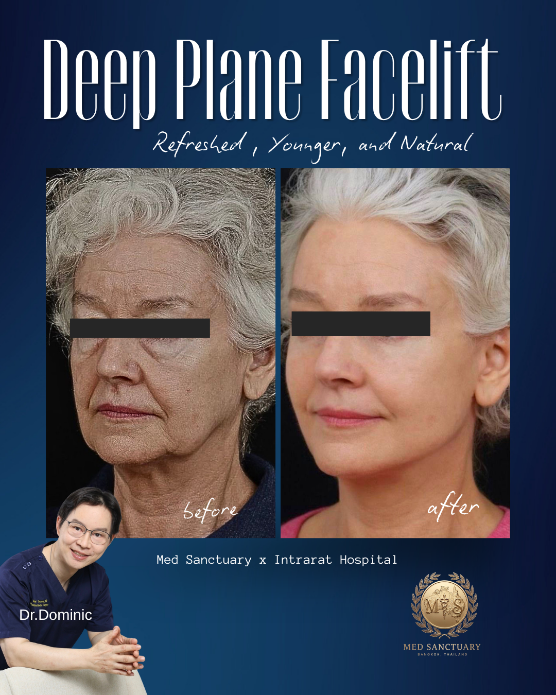 Before and after photos showing a woman with improved skin appearance after a deep plane facelift. The "before" photo depicts an older woman with wrinkles and sagging skin, while the "after" photo shows her with smoother, more youthful skin. The imag