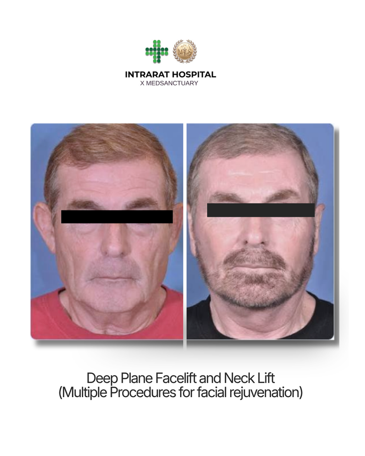 Before and after deep plane facelift and neck lift by Dr. Rushapol Sdawat, male patient, jawline and neck