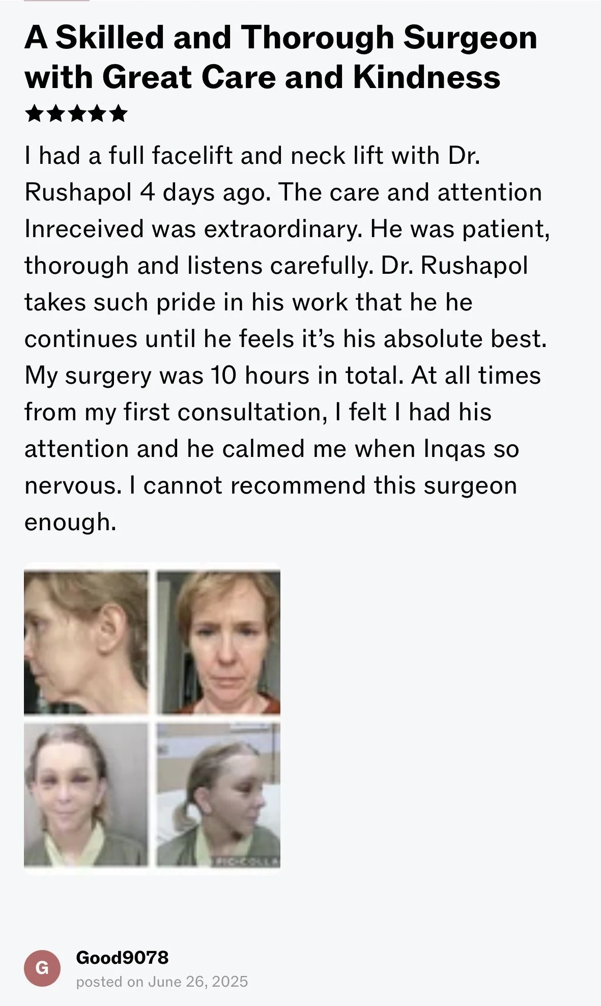 A collage of four photos showing a woman before and after a facelift, with a positive review describing her experience with Dr. Rushapol, who performed her facelift and neck lift.
